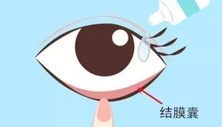 疫情期間，近視手術(shù)術(shù)后應(yīng)該如何保養(yǎng)?